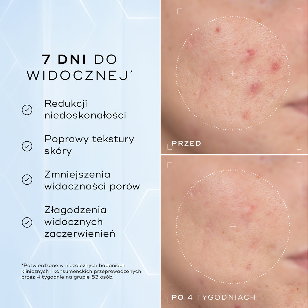 Zbliżenia policzka z zaczerwienieniem i problemami z teksturą skóry – zdjęcia „przed” i „po” 4 tygodniach, przedstawione obok siebie. Poniższy tekst zawiera informację: „Klinicznie udowodniono, że produkt widocznie zmniejsza zaczerwienienia i poprawia kondycję bariery skórnej*”.